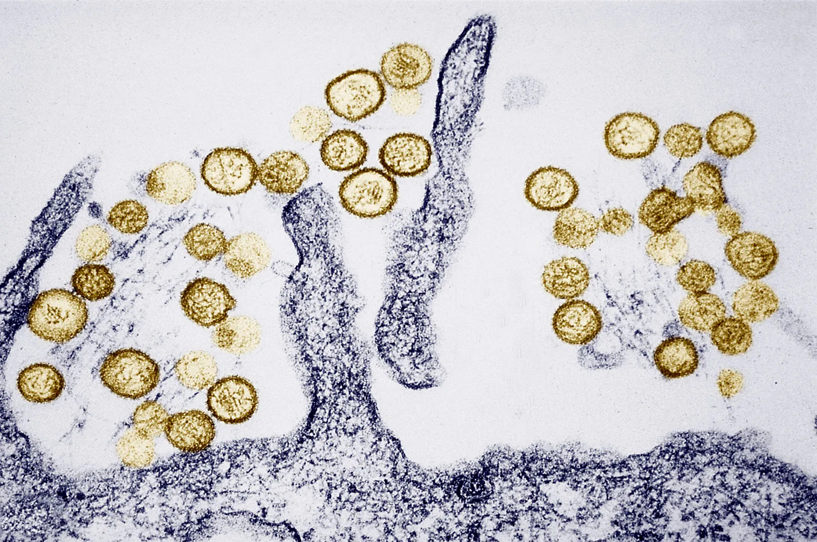 Hantavirus: Global Public Health Challenges