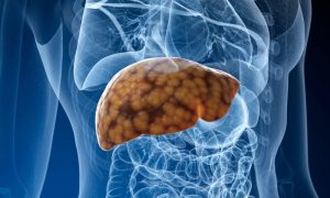 Liver and gallbladder diseases