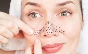 Circles and blackheads